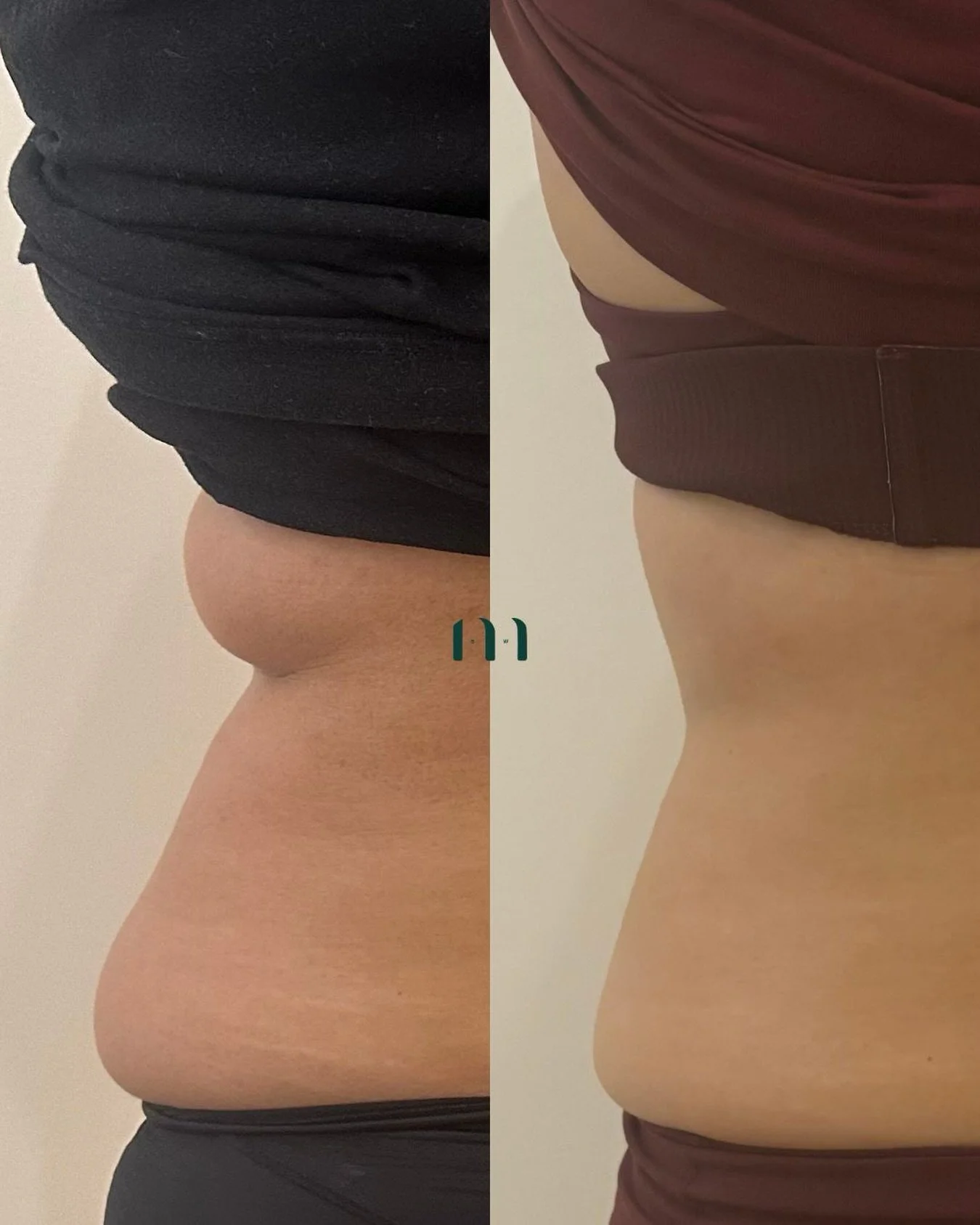 Struggling with hip, back or under-bra line fat/fluid build up? 🙋🏽&zwj;♀️

These are common areas for stagnation in women due to tight bra straps, clothing, posture and a sluggish lymphatic system.

Our body treatments focus on encouraging healthy 