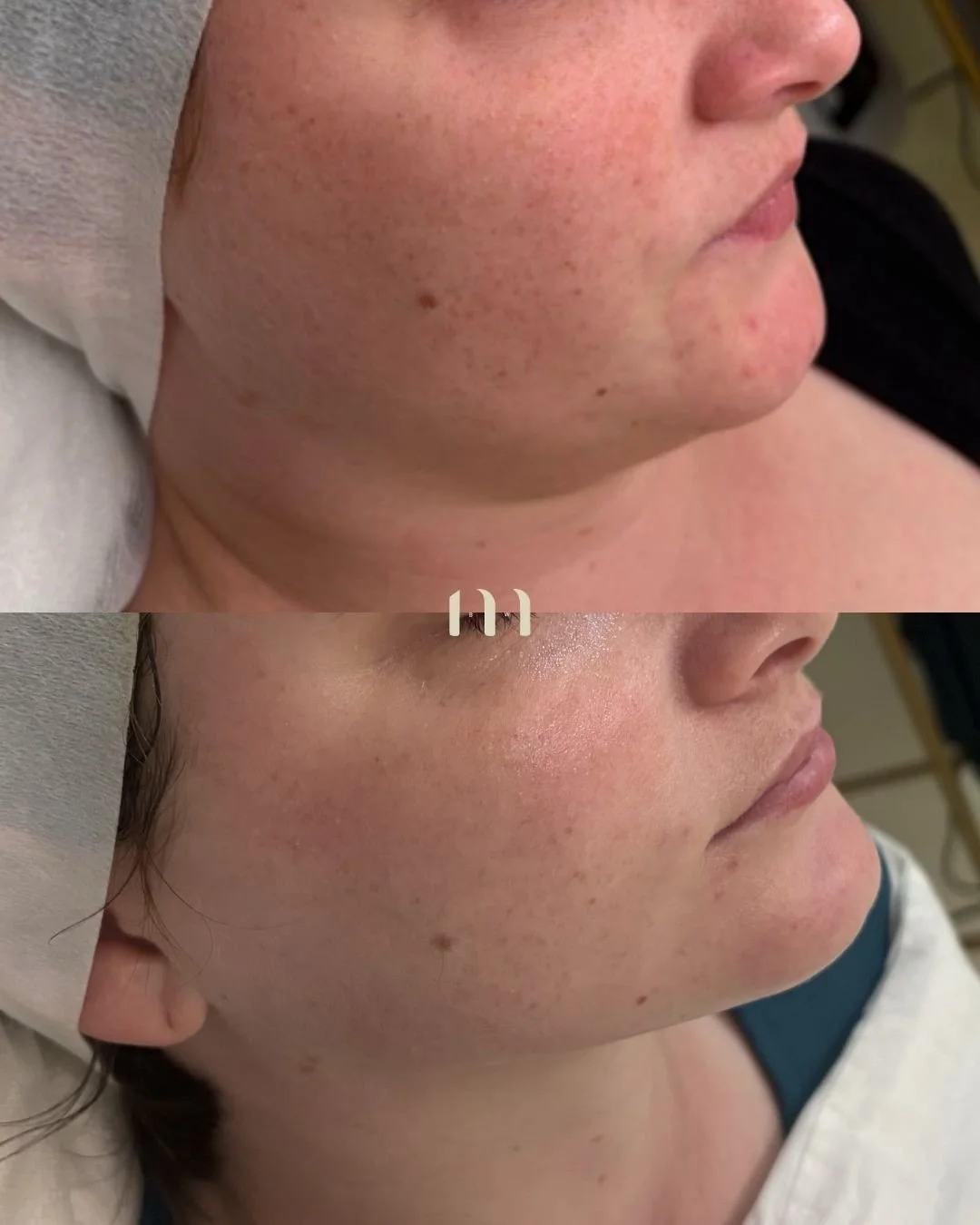 One year of consistent lymphatic drainage facials&hellip; here&rsquo;s what changed ✨

* Reduced facial puffiness and fluid retention
* More sculpted and defined jawline appearance
* Improved skin glow and overall radiance
* Smoother, more even-looki