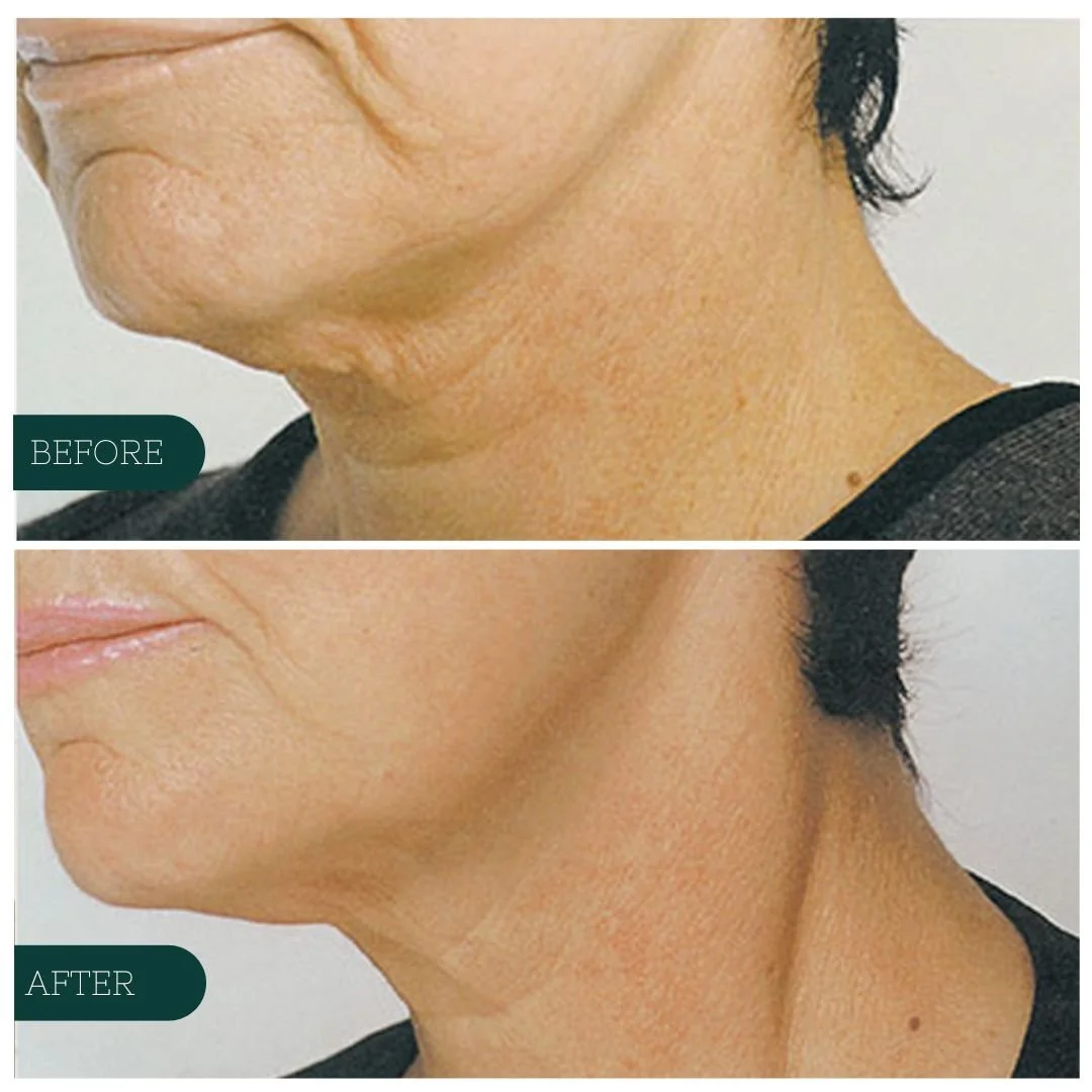 MEDI-LIFT — Meraki Beauty and Wellness