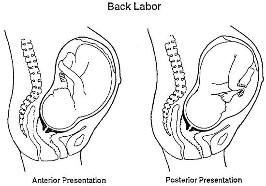 back labour.jpg