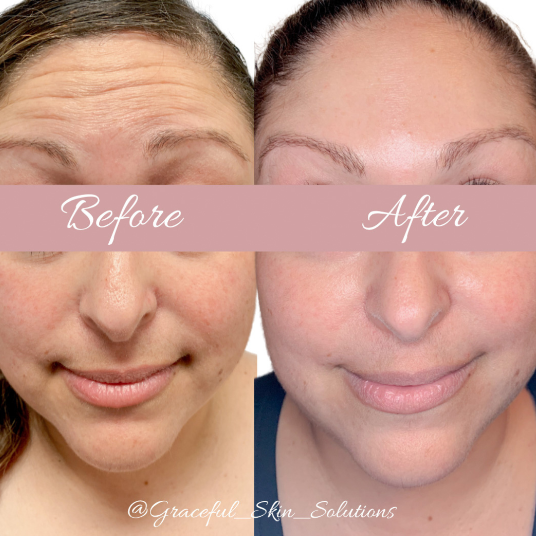 My Experience Using Olay Retinol24 Before After Photos 60 OFF my-experience-using-olay-retinol24-before-after-photos-60-off