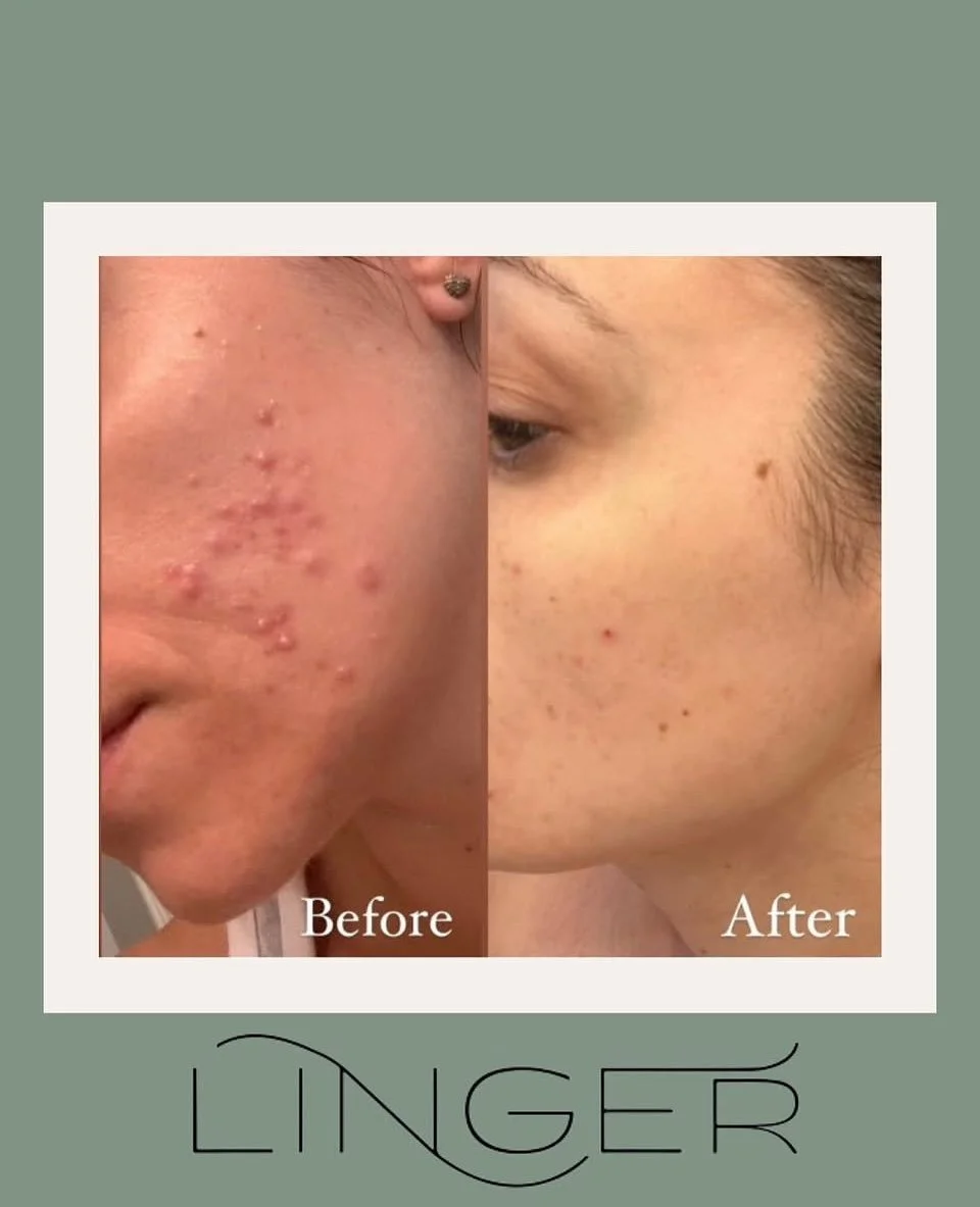 ✨Incredible skin transformation alert! ✨
We know finding the right skincare can be tricky and everyone&rsquo;s skin is different. That&rsquo;s why we offer free consultations to pinpoint your skin&rsquo;s unique needs and goals.

With over 22 years o