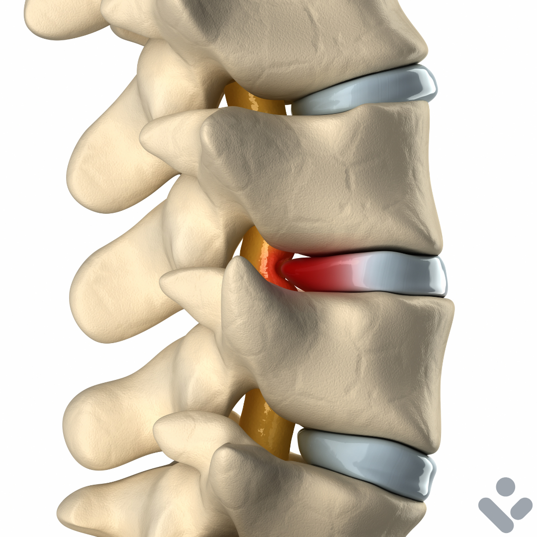 Disc Bulge: What It Actually Means (and Why It's Not as Scary as It Sounds)