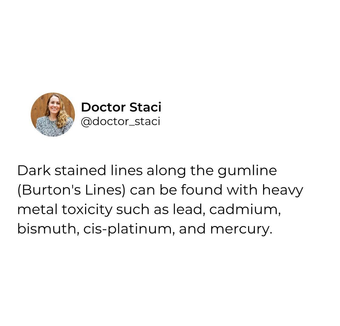 Dark staining in teeth can be from many things:  excess iron or trace minerals, chromatic bacteria, coffee and smoking, oral microbiome dysbiosis, lots of berries in the diet, wine or alcohol consumption, or it can be a sign of heavy metal toxicity. 