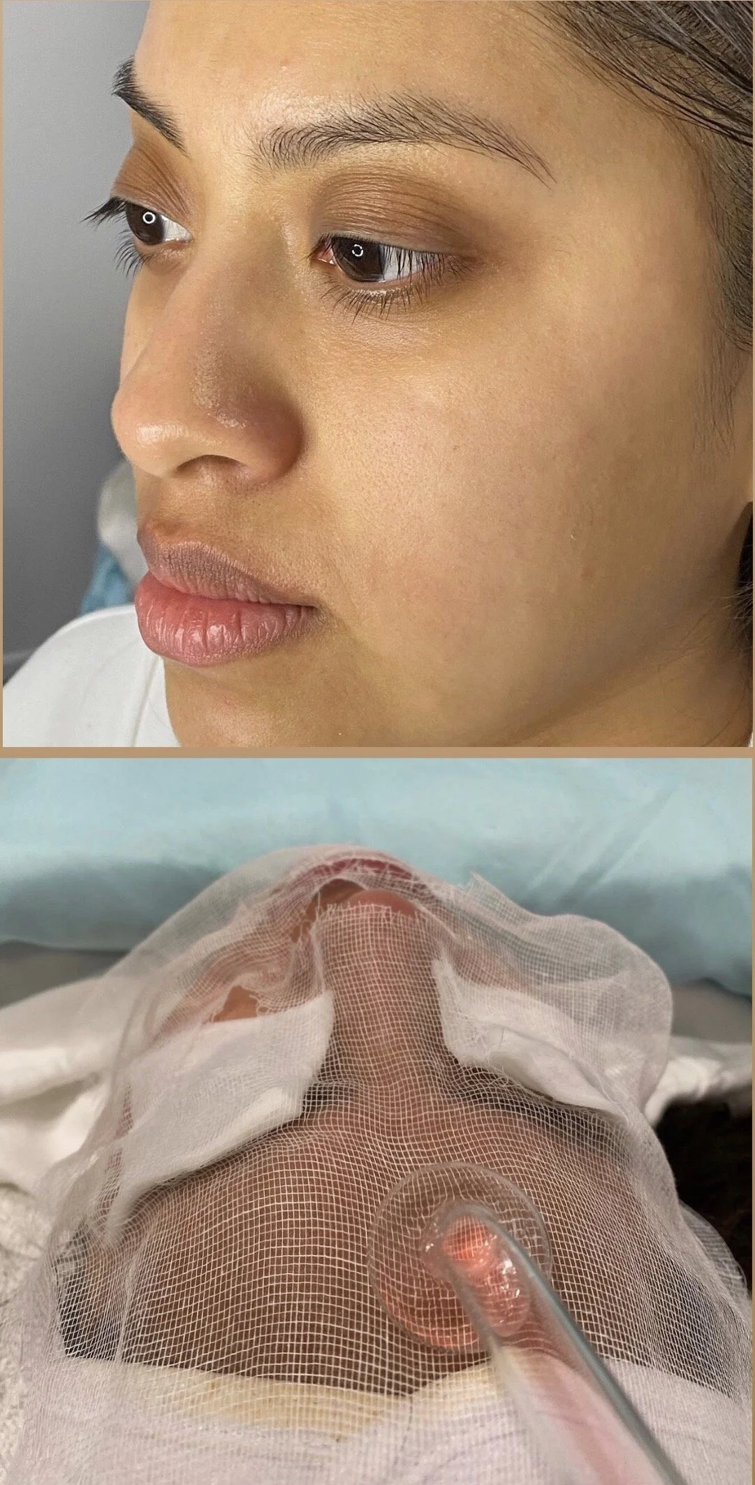 High-frequency  facial
