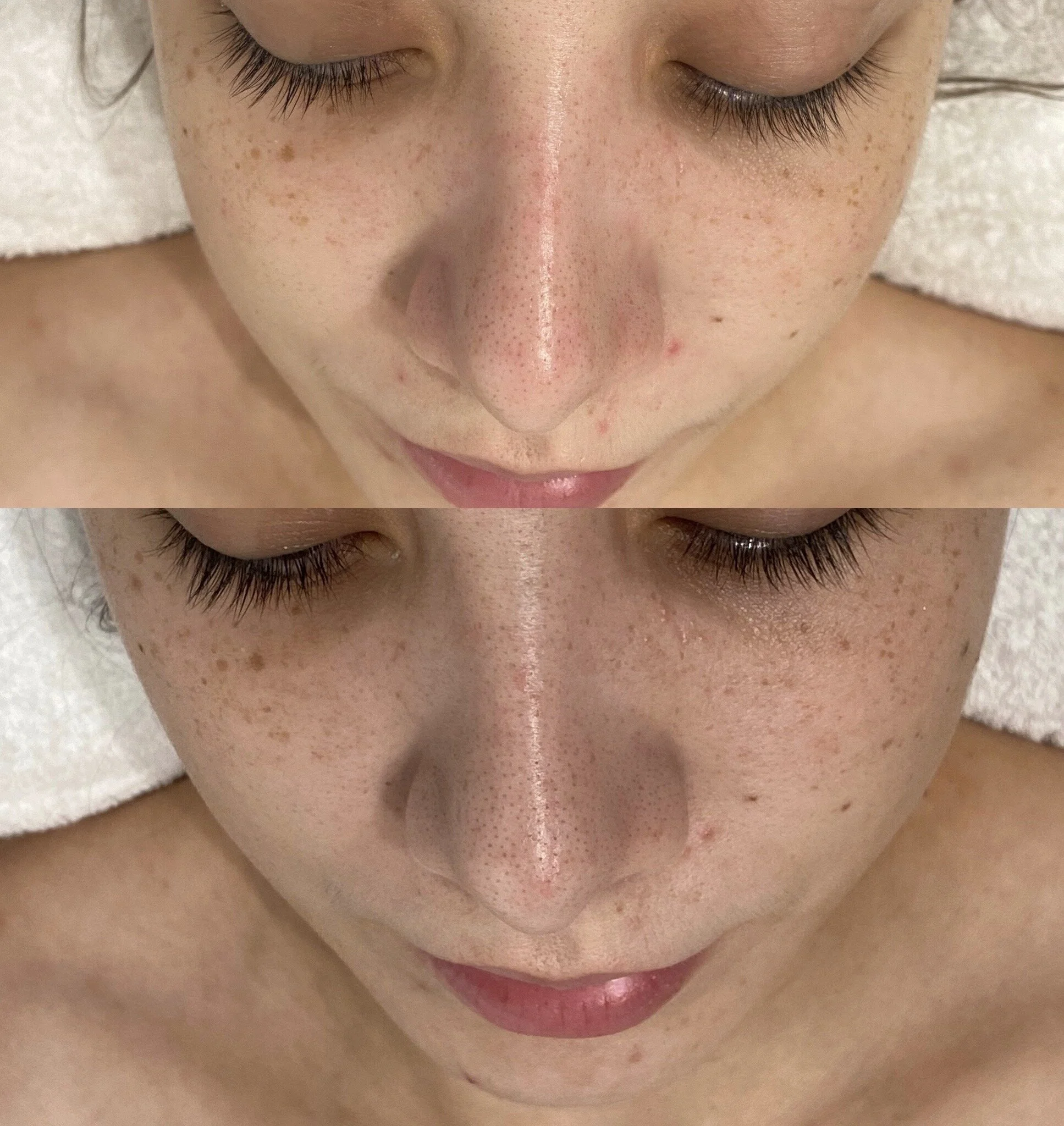 A before/After picture of  Mini acne treatment and Extraction facial 