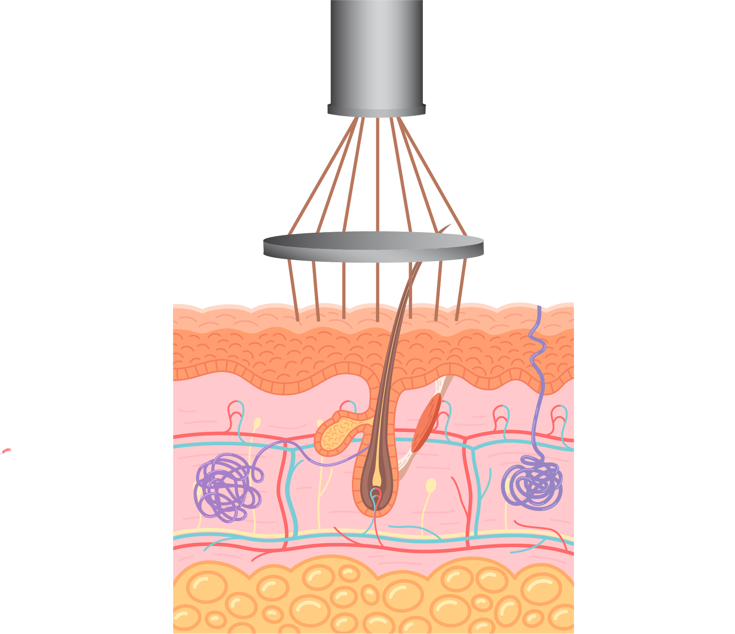 CO2 laser penetrating skin layers