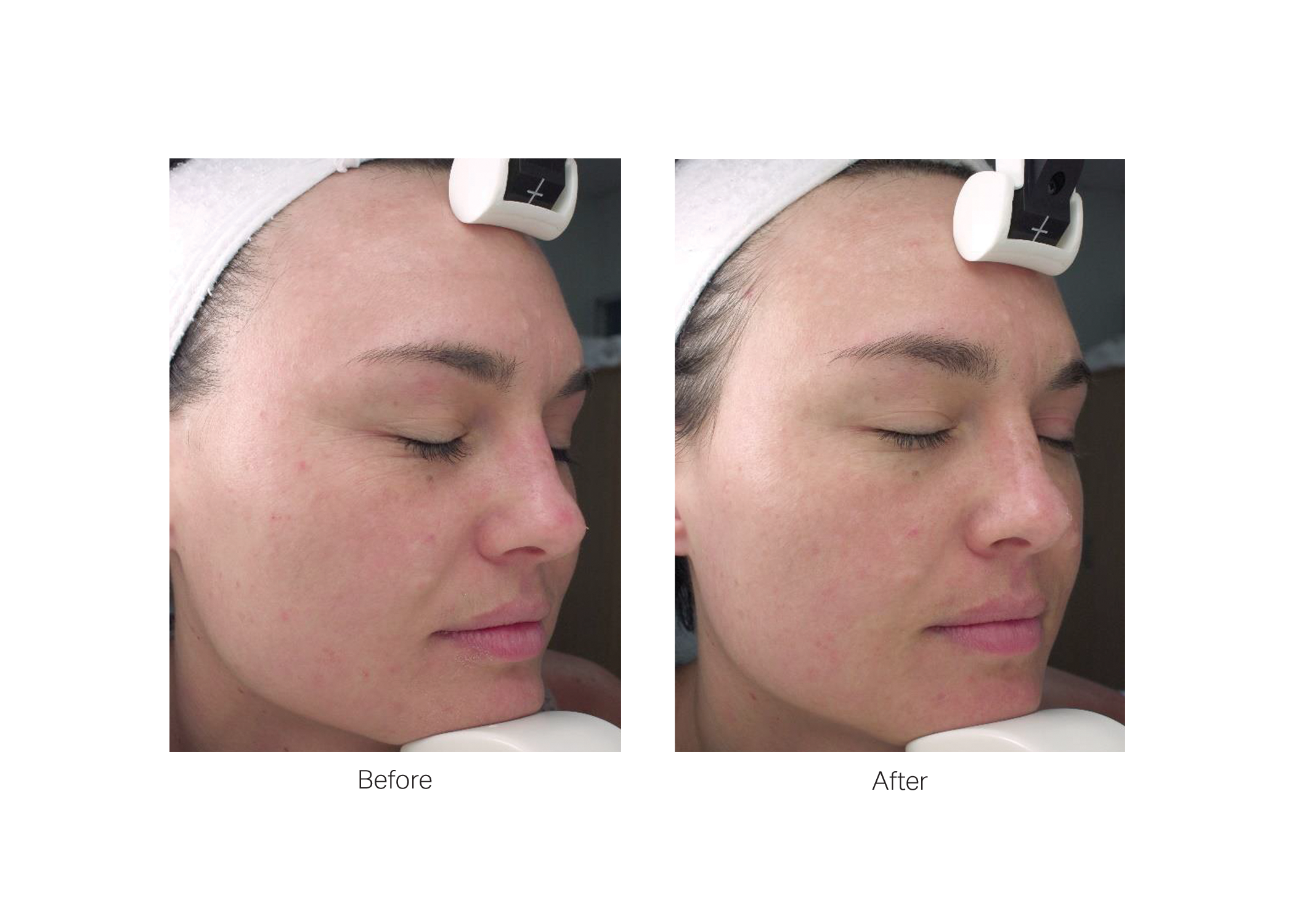 LumiMax photobiomodulation aesthetic device — Estetique USA