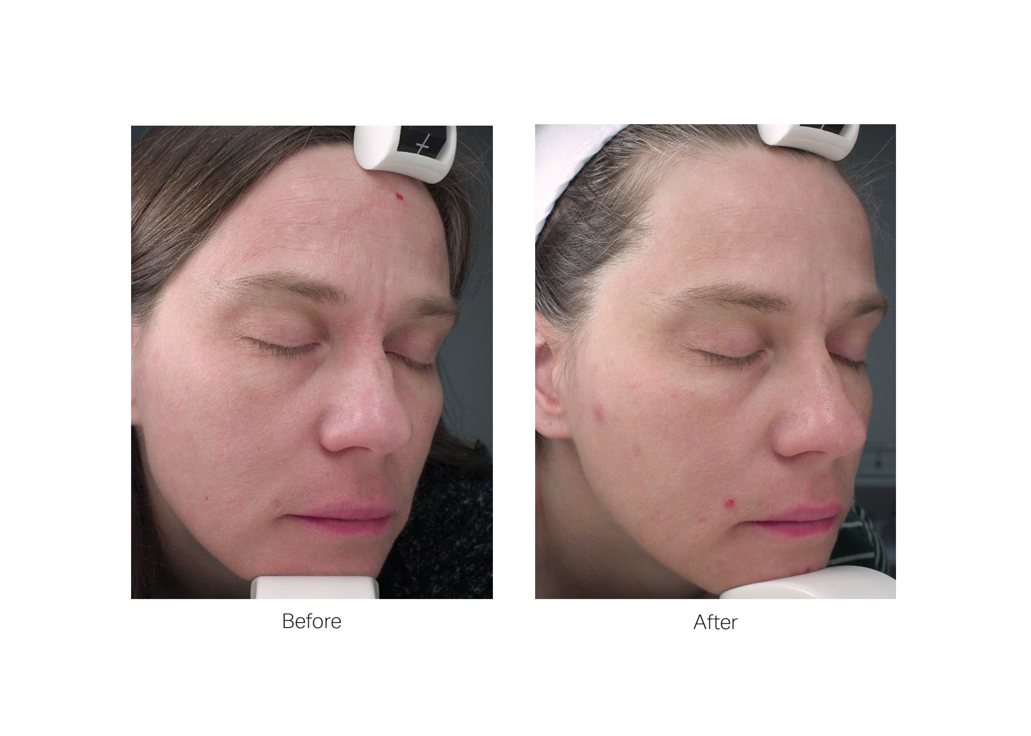 LumiMax photobiomodulation aesthetic device — Estetique USA