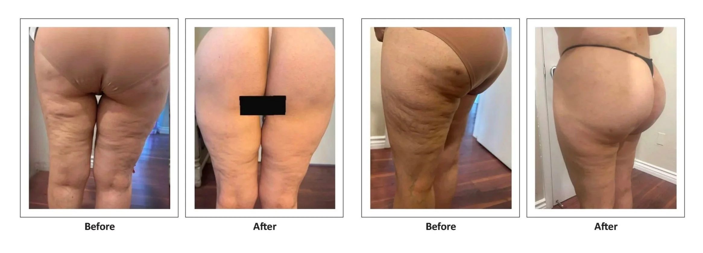 Cellulite before and after