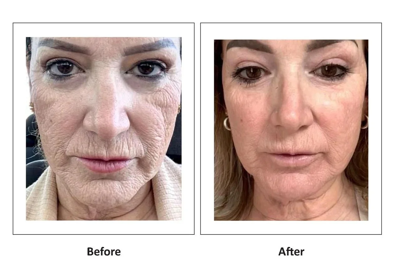 Fine lines and wrinkles before and after with LumiMax CO2
