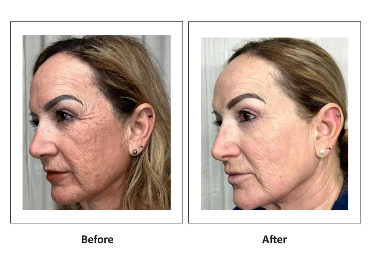 LumiMax CO2 deep wrinkles result, view 2