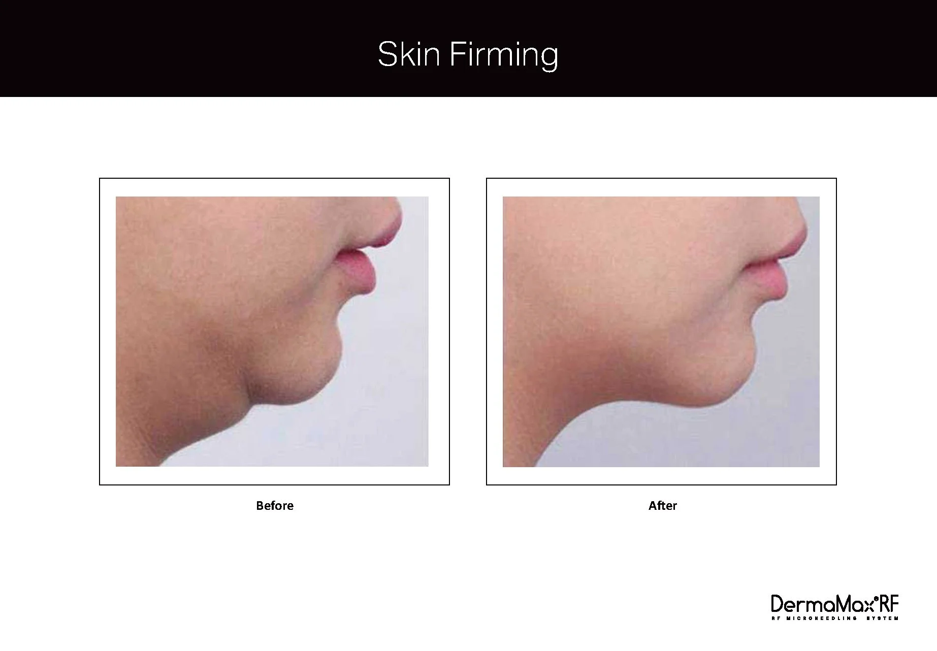 Clinical Studies Dermamax RF_ENG_V1.0_Page_10.jpg