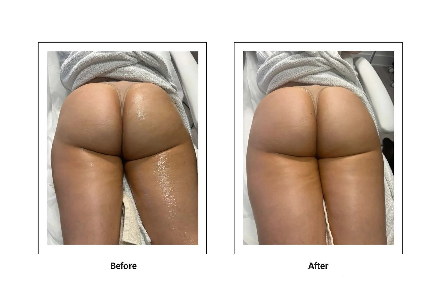Body treatment
