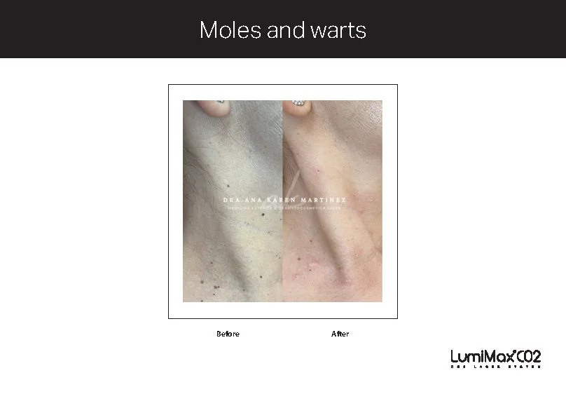 Clinical Studies LMX CO2_ENG_V1.0_Page_13.jpg