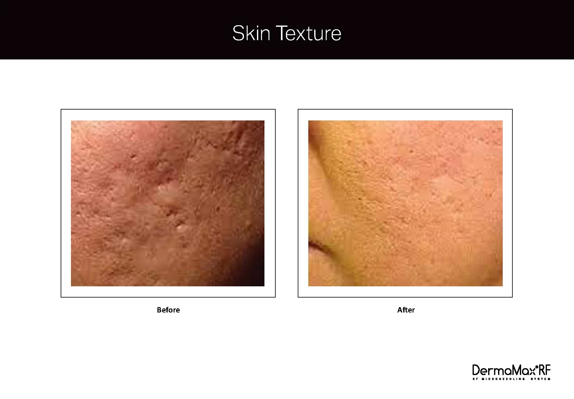 Clinical Studies Dermamax RF_ENG_V1.0_Page_09.jpg