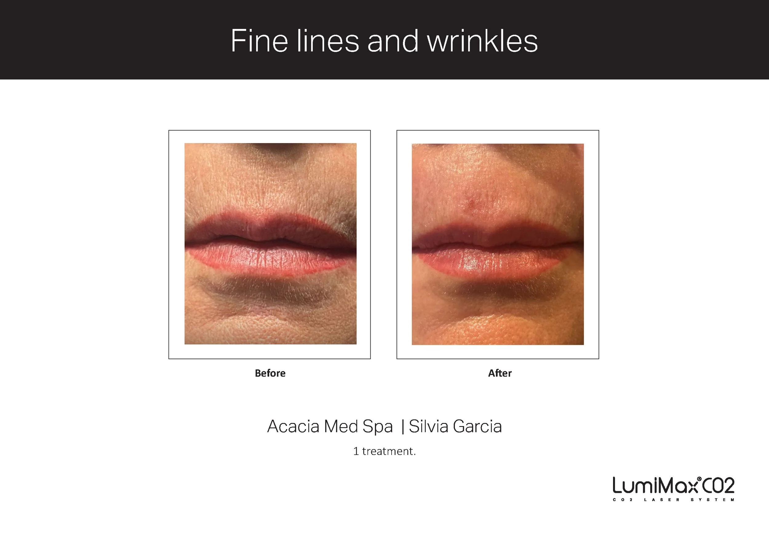 Clinical Studies LMX CO2_ENG_V1.1 (dragged)_Page_2.jpg