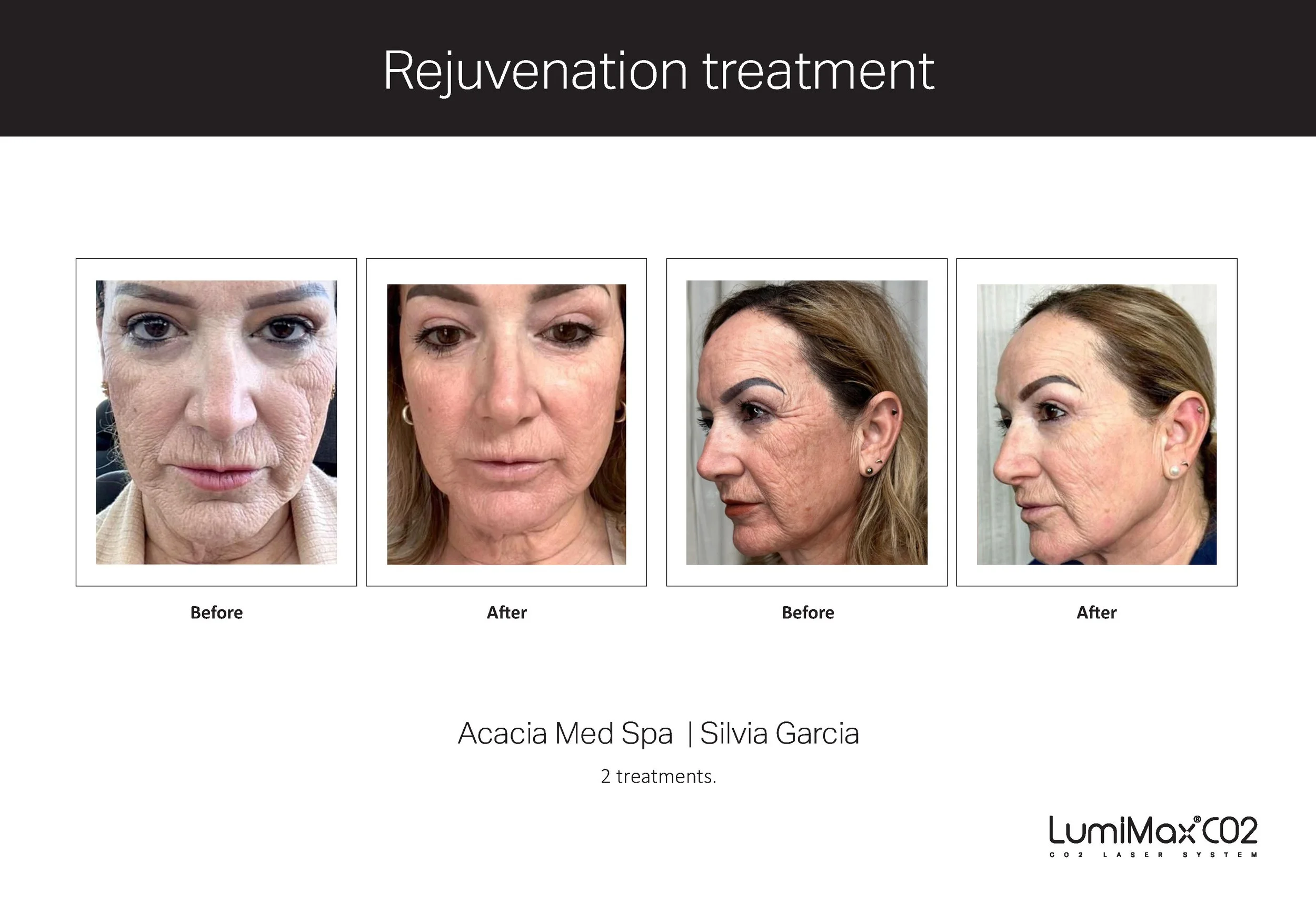 Clinical Studies LMX CO2_ENG_V1.1 (dragged)_Page_3.jpg