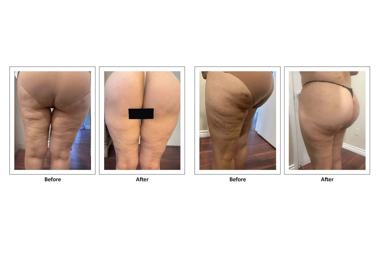 Cellulite treatment