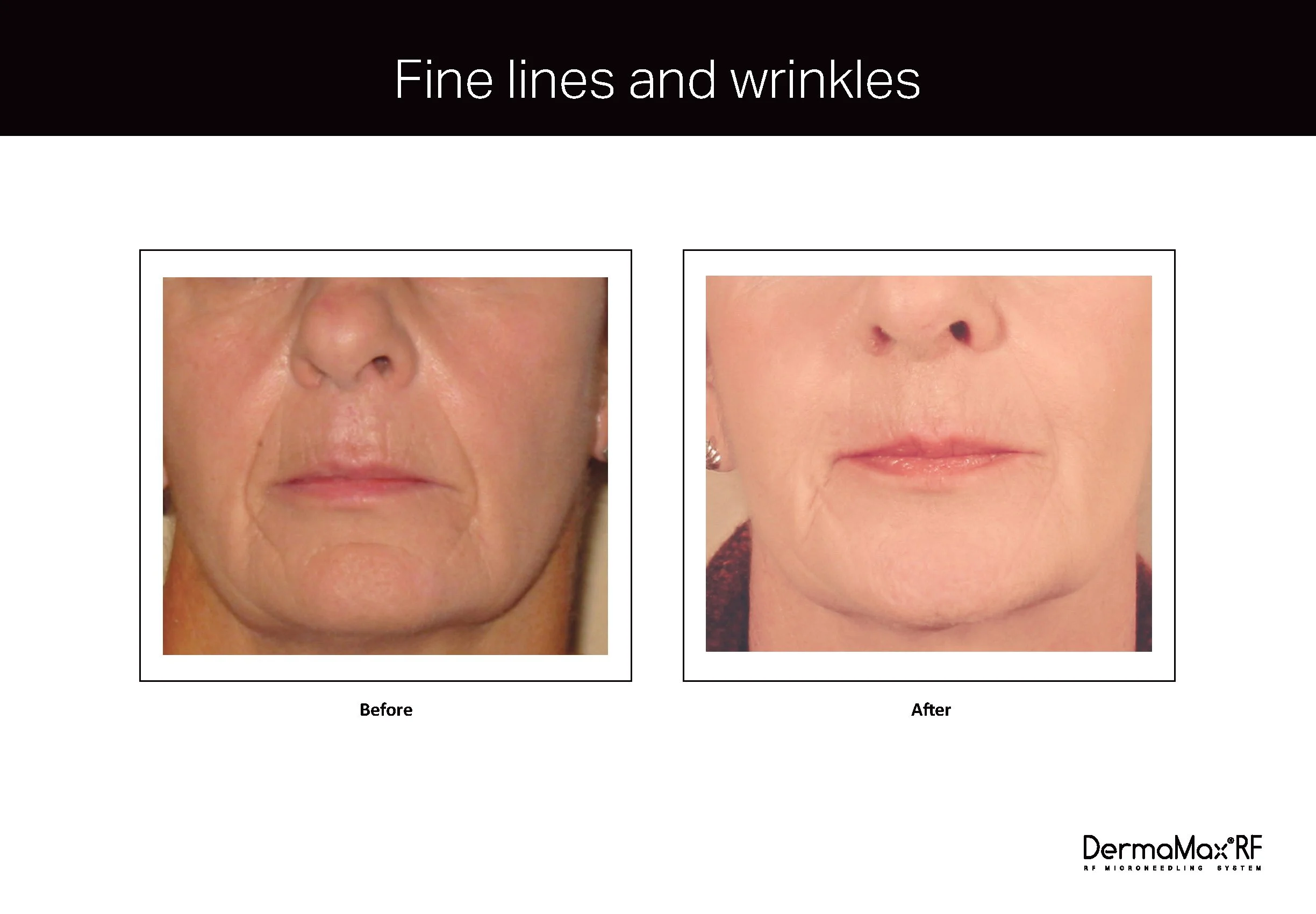 Clinical Studies Dermamax RF_ENG_V1.0_Page_04.jpg