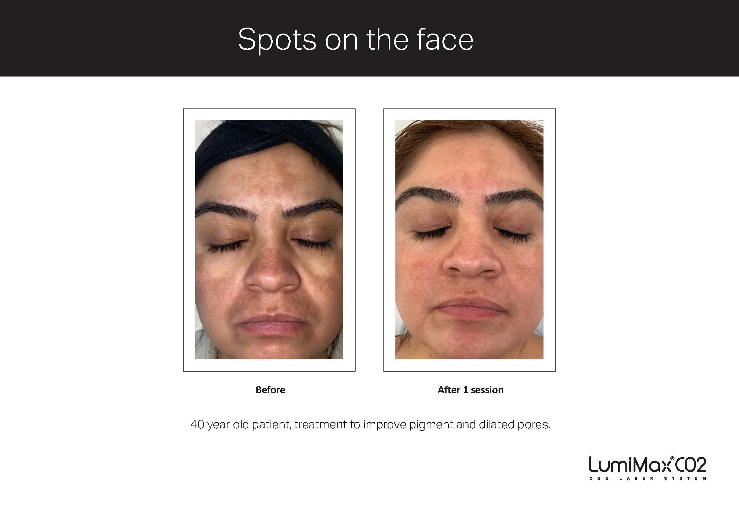 Clinical Studies LMX CO2_ENG_V1.0_Page_12.jpg