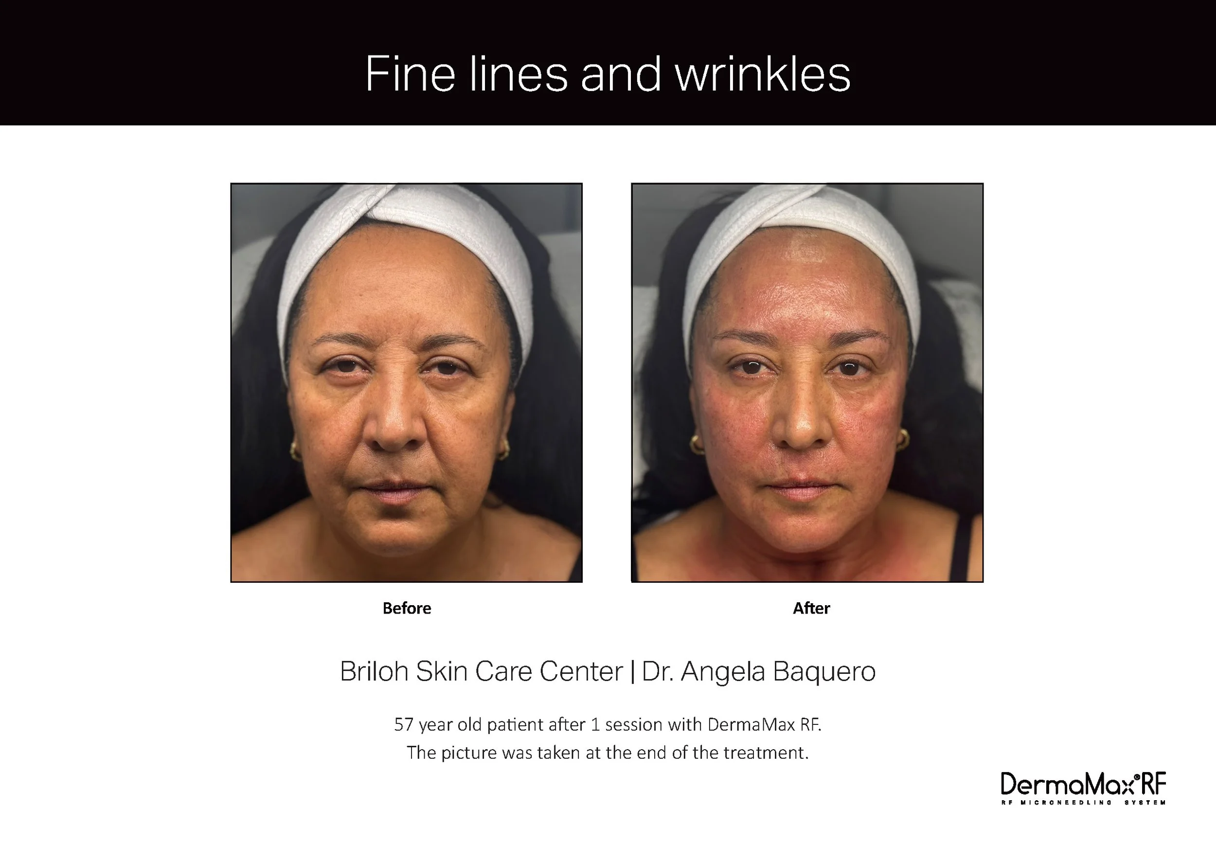 Clinical Studies Dermamax RF_ENG_V1.0_Page_02.jpg