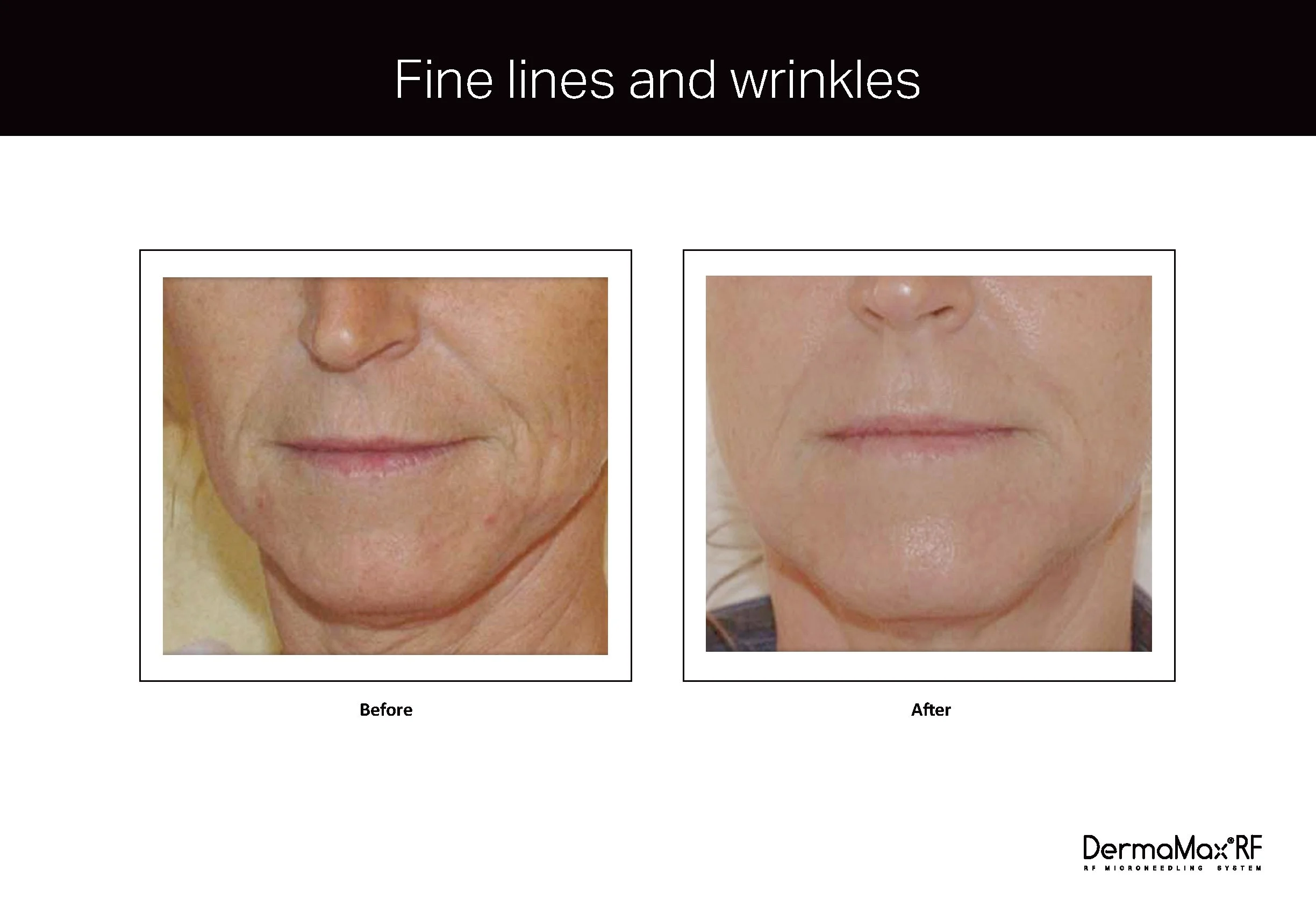 Clinical Studies Dermamax RF_ENG_V1.0_Page_05.jpg