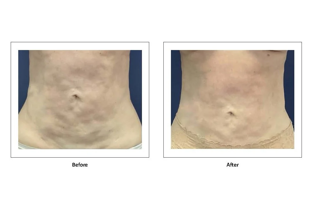 Fibrosis treatment