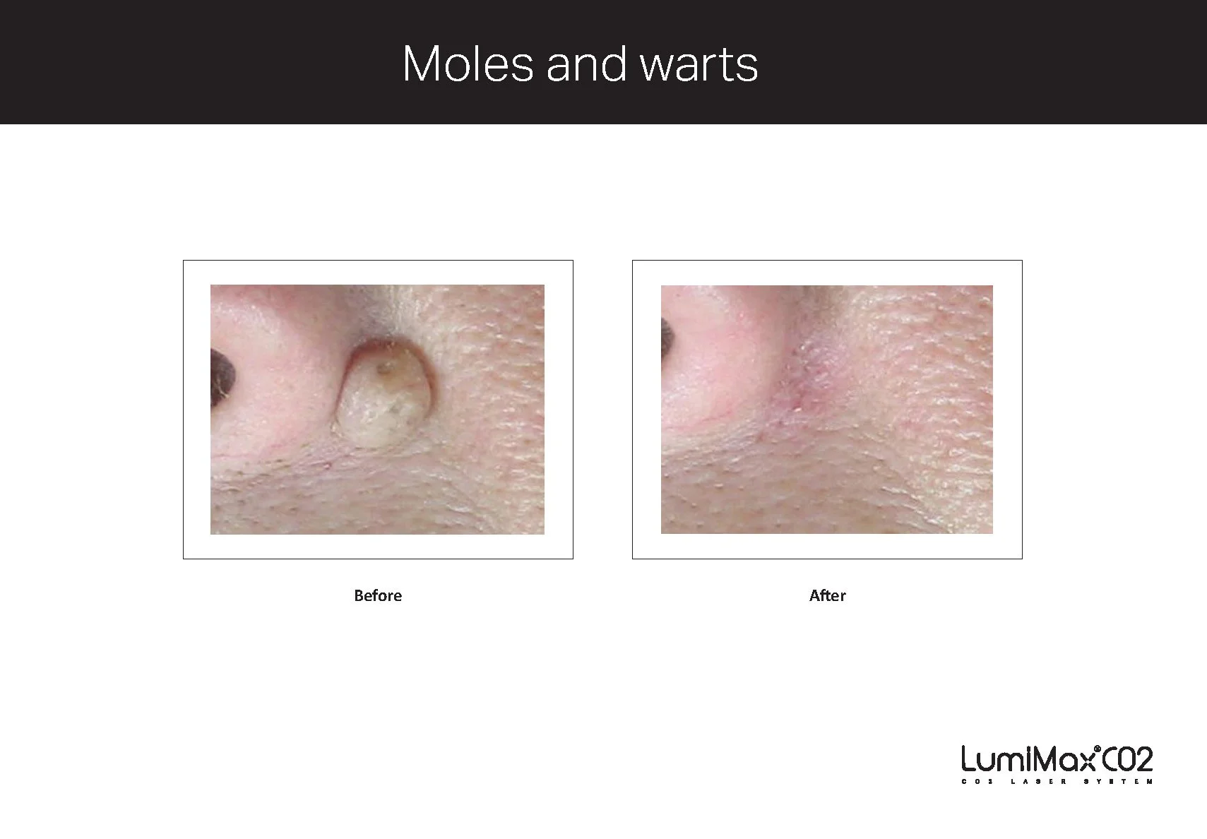 Clinical Studies LMX CO2_ENG_V1.0_Page_14.jpg