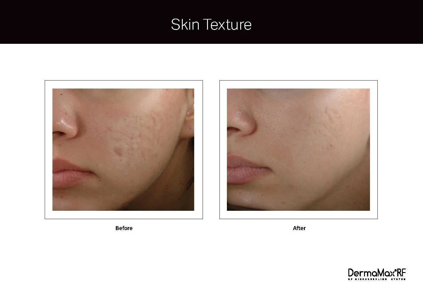 Clinical Studies Dermamax RF_ENG_V1.0_Page_08.jpg