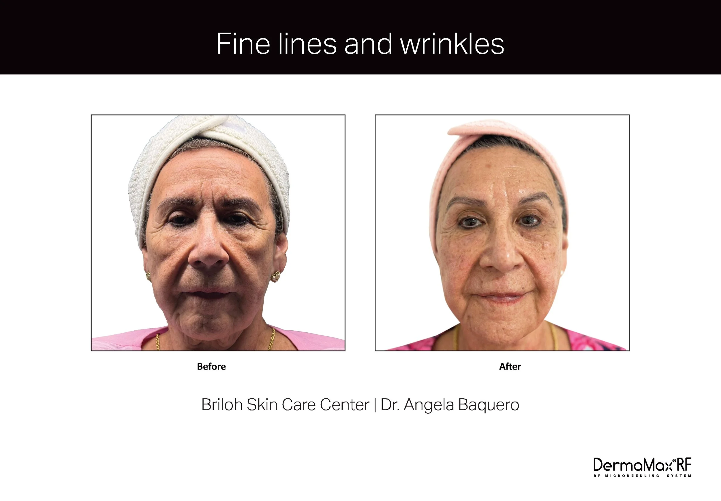 Clinical Studies Dermamax RF_ENG_V1.0_Page_03.jpg