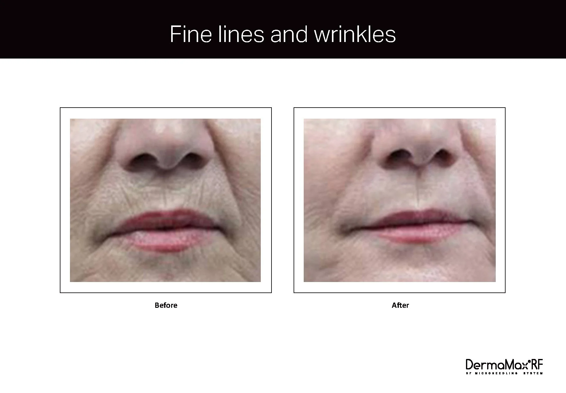 Clinical Studies Dermamax RF_ENG_V1.0_Page_06.jpg