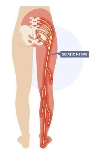 I used to have Sciatica