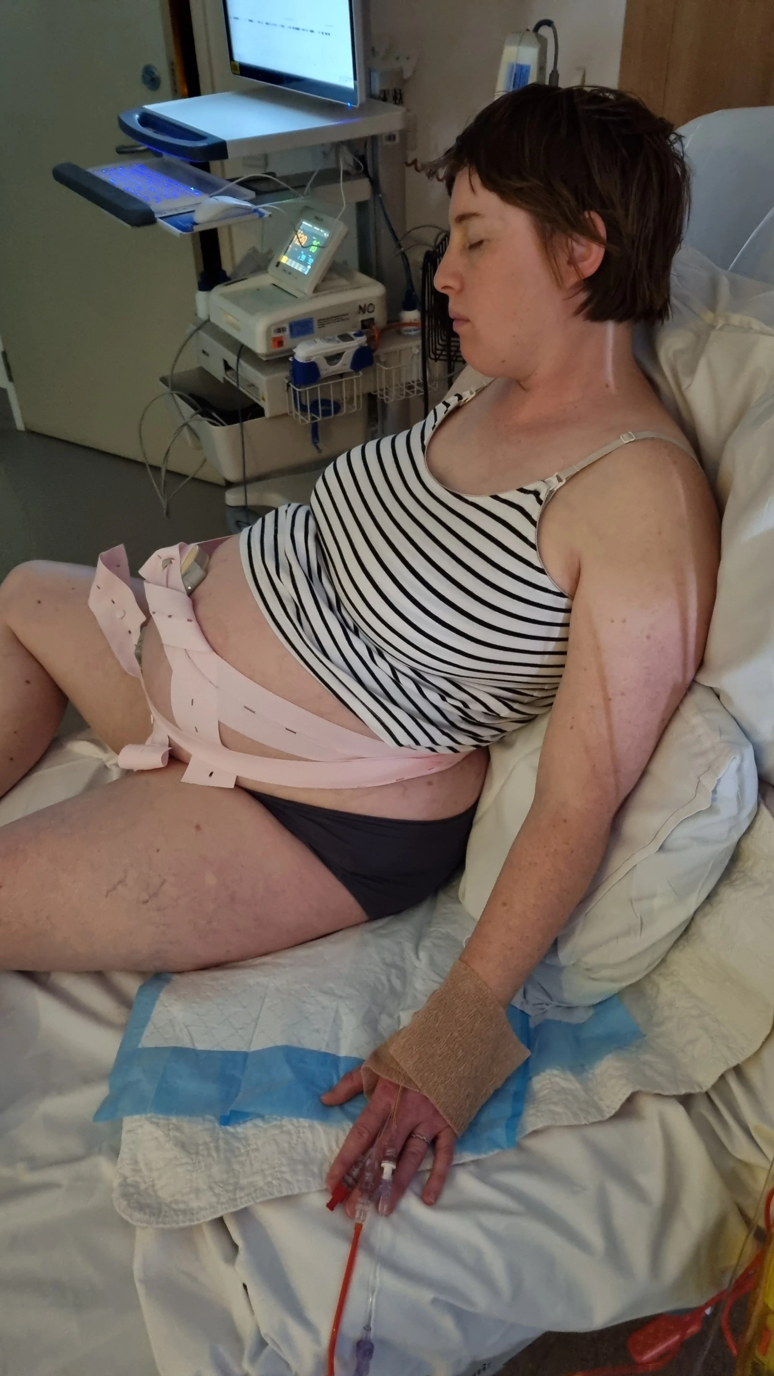 Prolonged rupture of membranes, Induction of Labour - Michelle