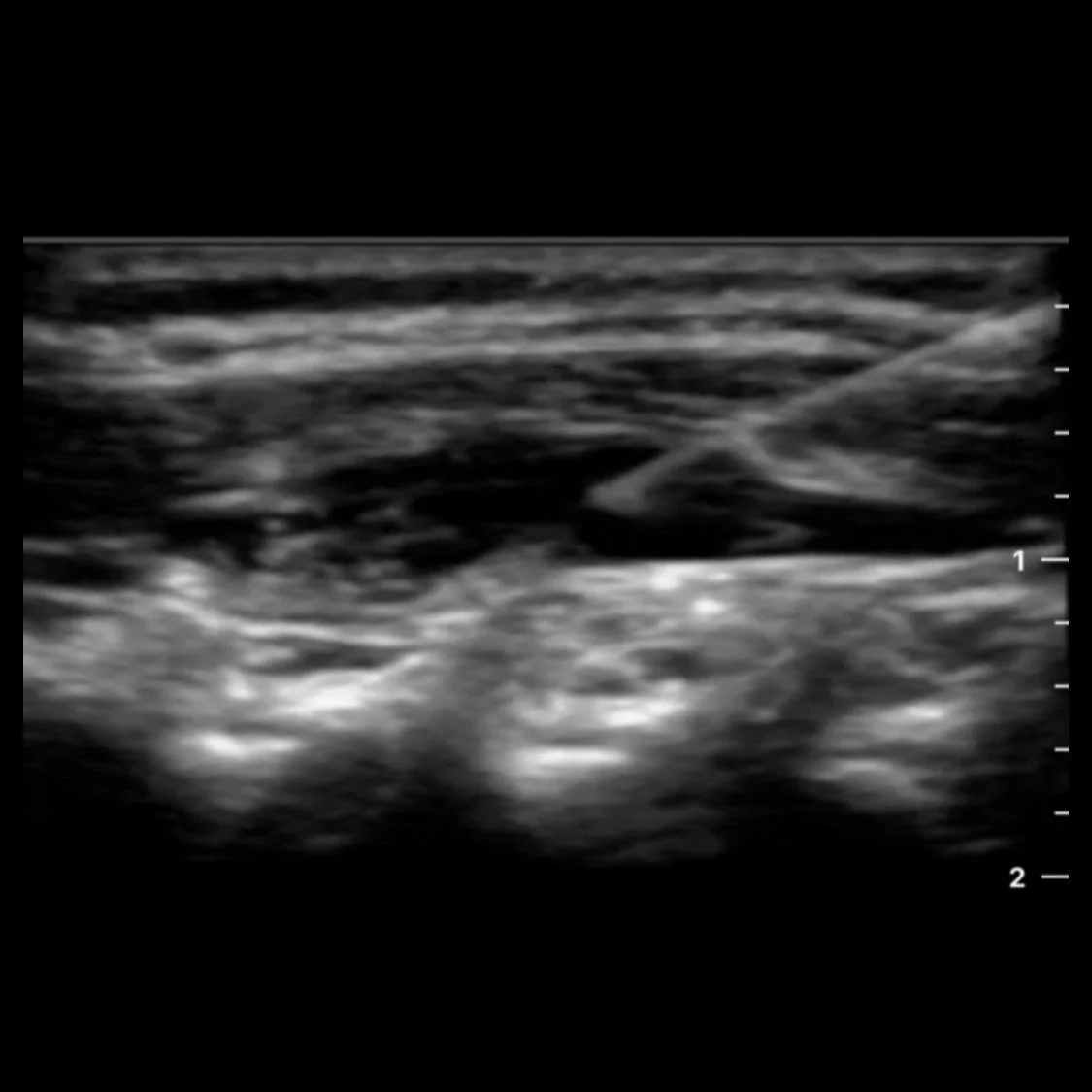 Espb Block Ultrasound-Guided Thoracic Erector Spinae Plane Block in Pediatric ...