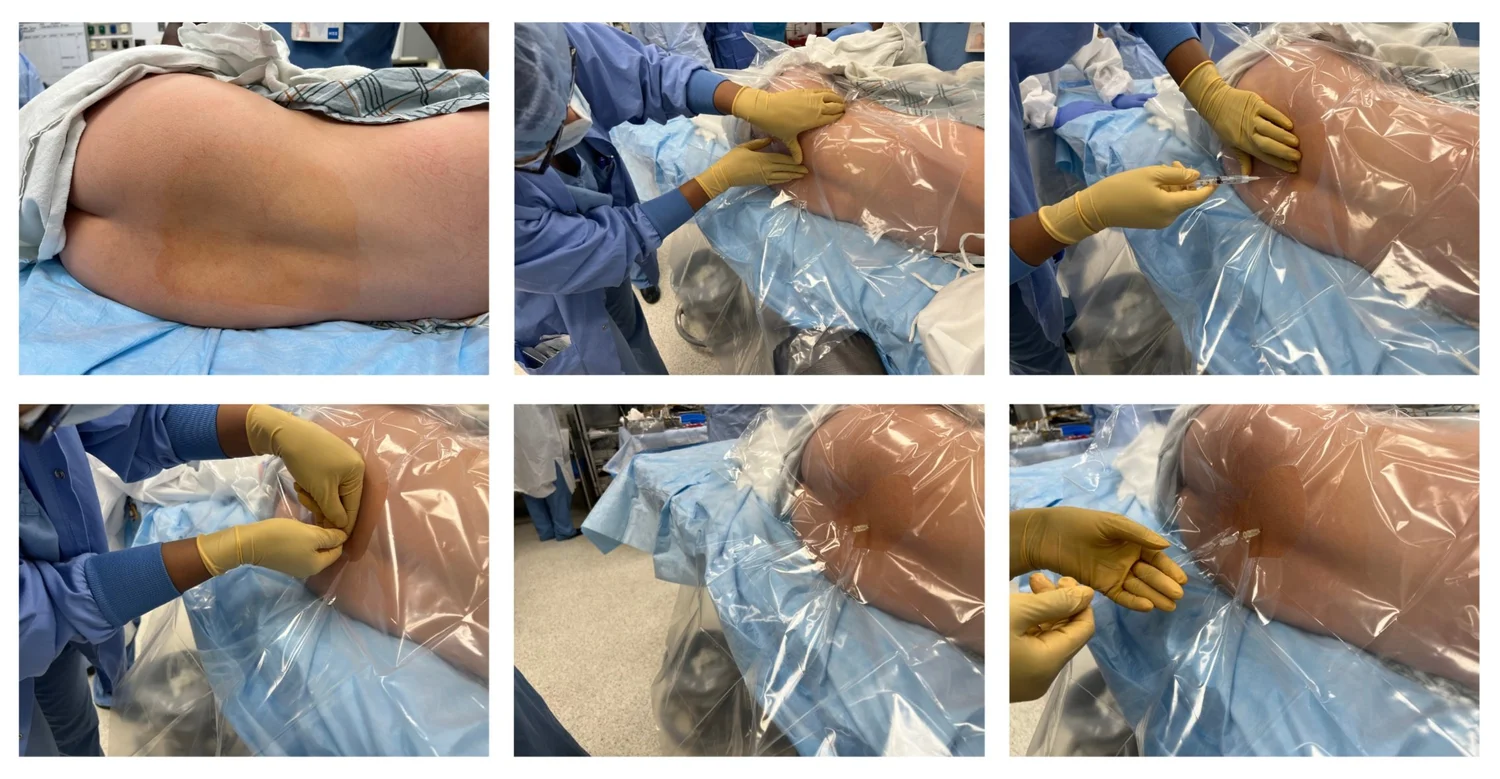Pediatric Spinal Anesthesia: Technique & Dosing | Baby Blocks — BABY BLOCKS