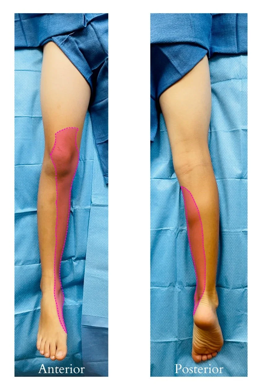 Adductor Canal Block — BABY BLOCKS