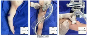 PENG Block: Ultrasound-Guided Hip Analgesia — BABY BLOCKS