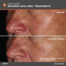 Environ Cool Peel B&A 4.jpeg