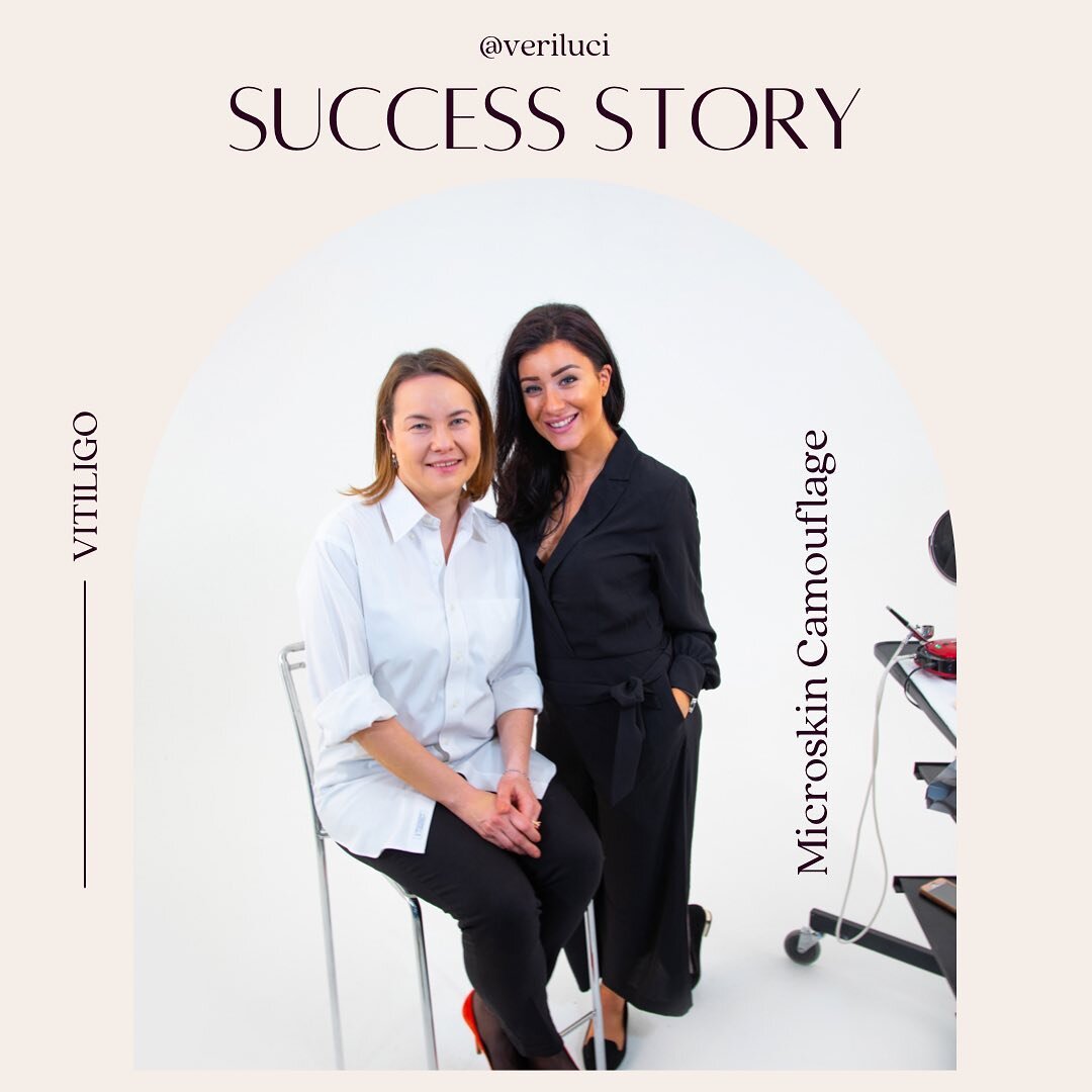 SUCCESS STORY - Camouflage by MICROSKIN ... #veriluci
&mdash;&mdash;&mdash;&mdash;&mdash;&mdash;&mdash;&mdash;&mdash;&mdash;&mdash;&mdash;&mdash;&mdash;&mdash;&mdash;-
When I met Natalia she was 3 years into her Vitiligo journey , with loss of pigmen