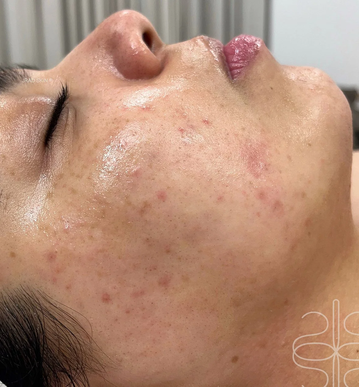 After cheek close-up showing reduced visible congestion, fewer blemishes and a smoother-looking skin tone across the lower cheek.