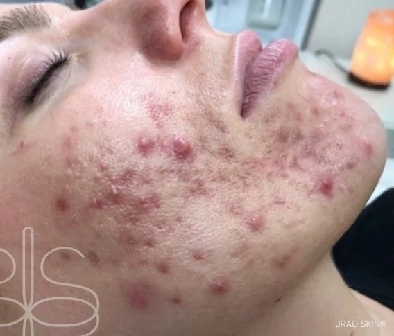 Before cheek close-up showing inflamed cystic breakouts, congestion, acne scarring and post-inflammatory pigmentation on the lower cheek.
