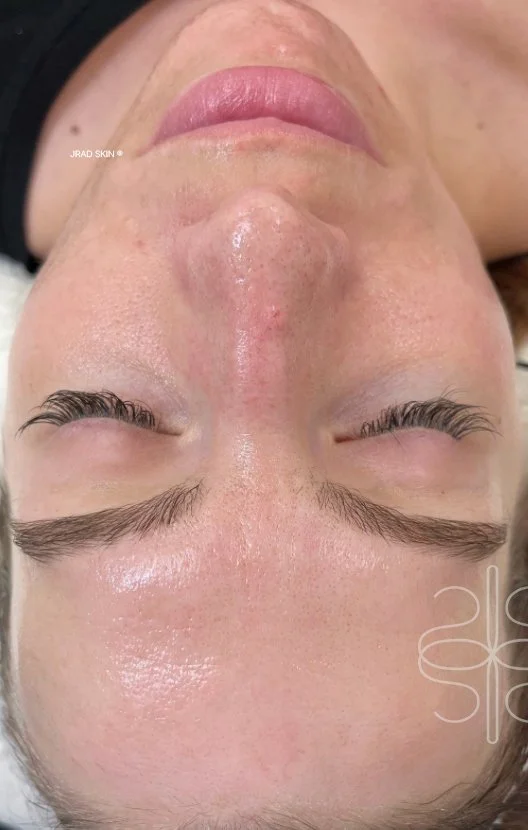 After front-facing image showing clearer-looking skin, reduced congestion and a smoother-looking tone across the cheeks, chin and lower face.