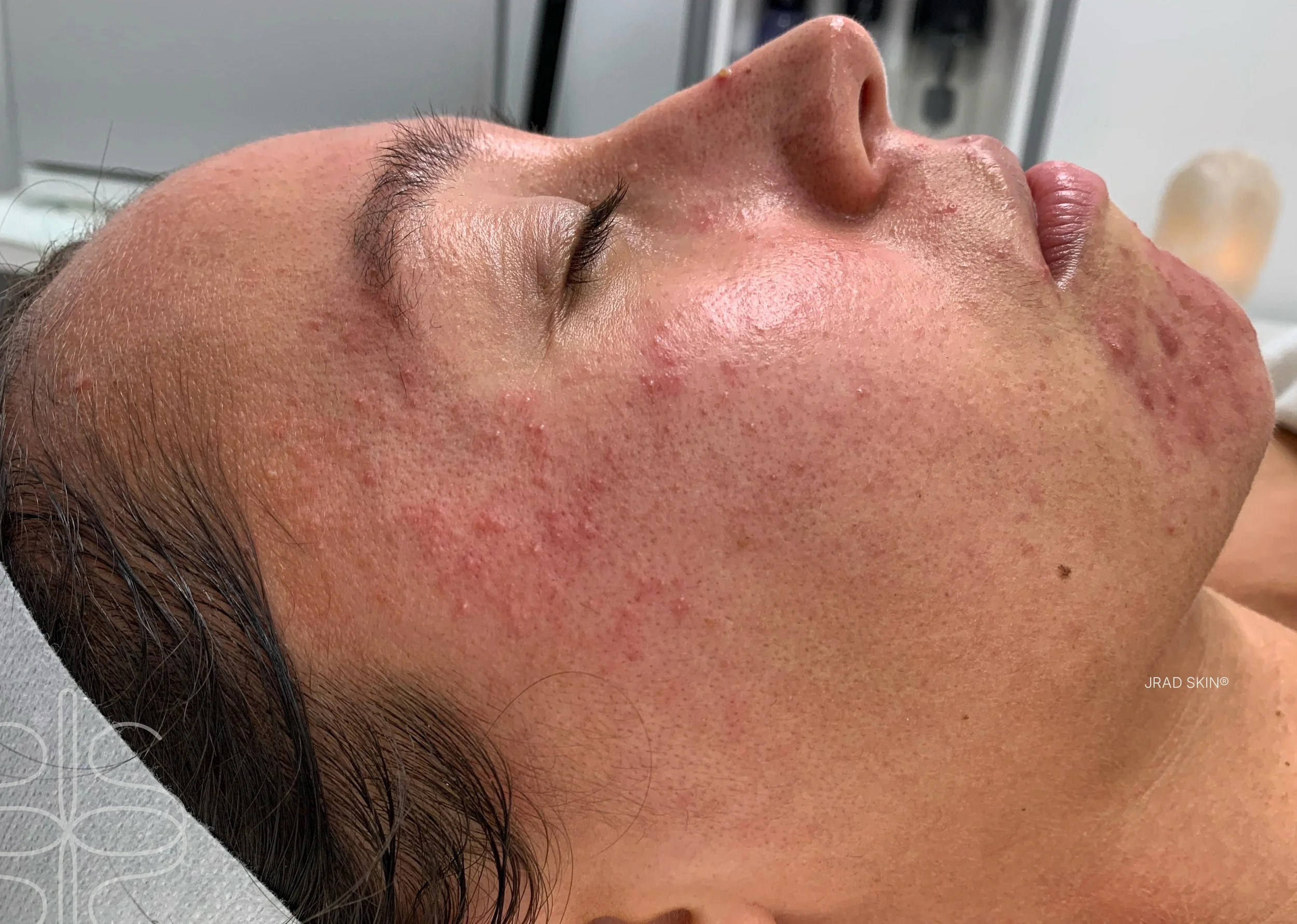 Before side-profile image of Stacey showing facial redness, papulopustular rosacea and hormonal acne across the cheek and chin.