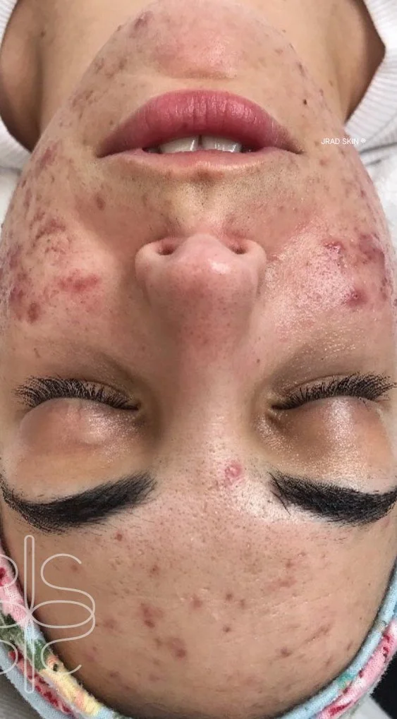 Before treatment image showing widespread inflamed breakouts, post-inflammatory pigmentation and uneven skin texture across the cheeks and chin