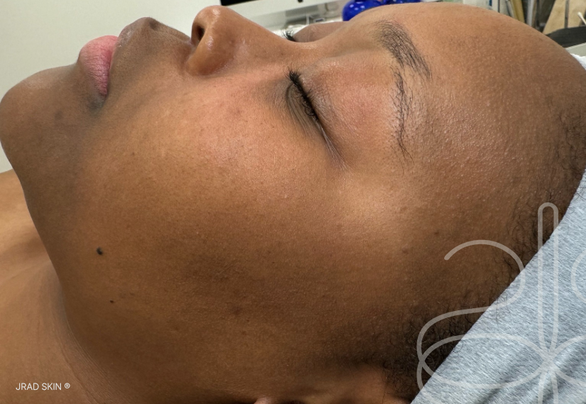 Before image showing visible discolouration, uneven texture and congestion prior to JRAD SKIN treatment plan