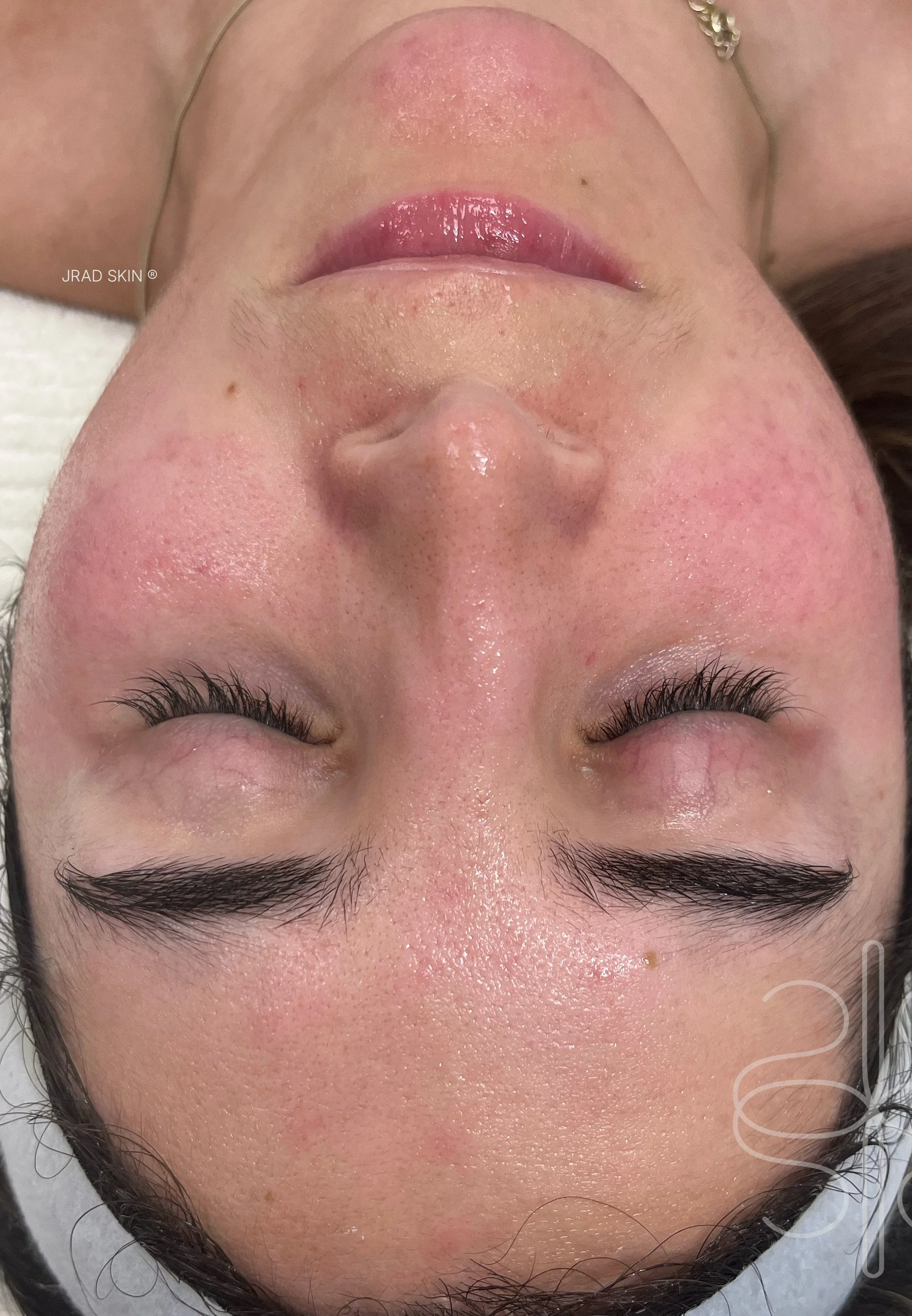 After image showing calmer-looking skin with improved visible clarity and reduced post-inflammatory pigmentation following JRAD SKIN treatment plan