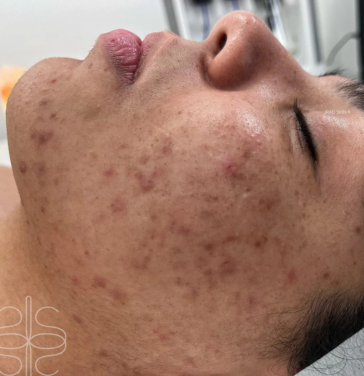 Before side-profile close-up showing pigmentation, congestion and pustules across the cheek, jawline and lower face.