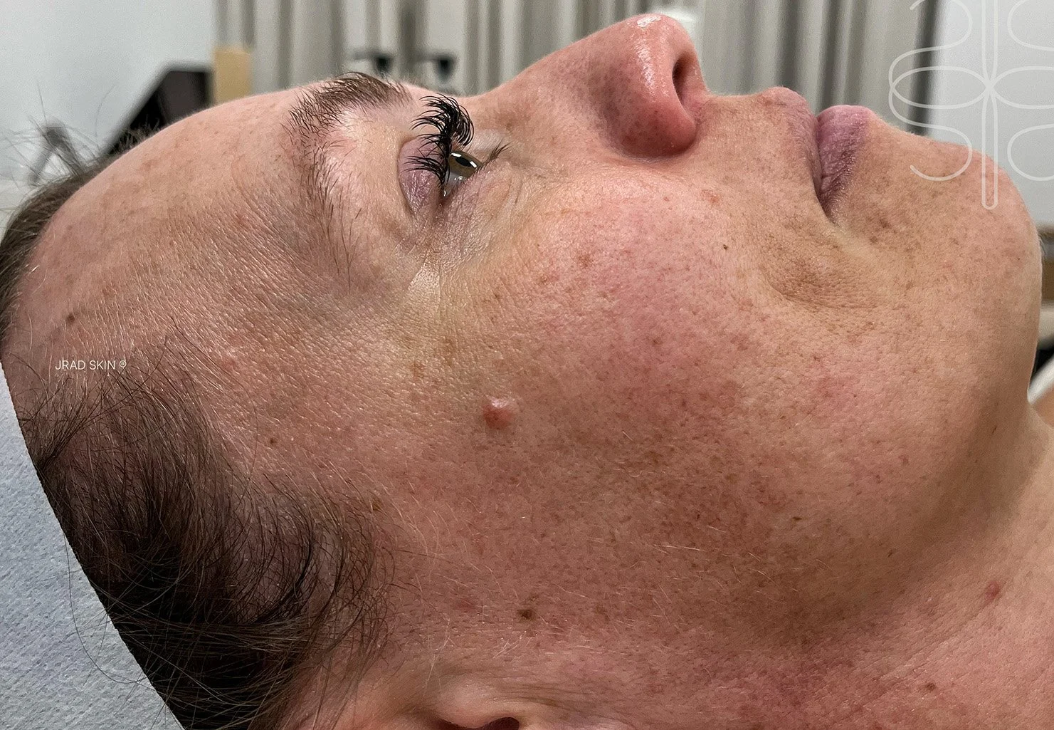 Before side-profile image of Kaela showing visible sun damage, pigmentation and uneven texture across the cheek