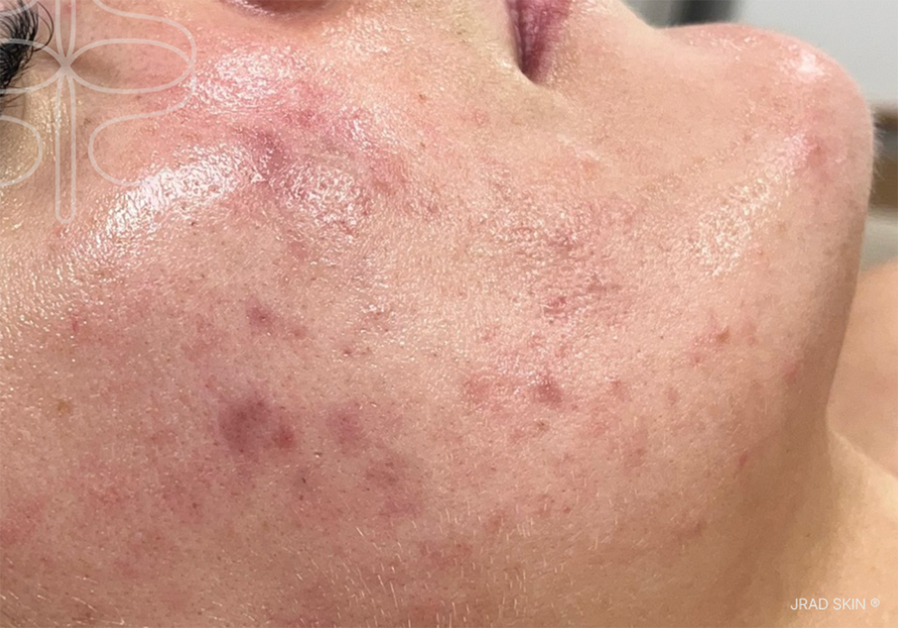 After close-up image showing fewer visible blemishes, calmer-looking skin and softened post-inflammatory pigmentation around the lower cheek and chin